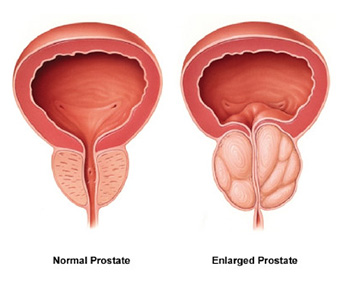 Tratamentul adenomului de prostata