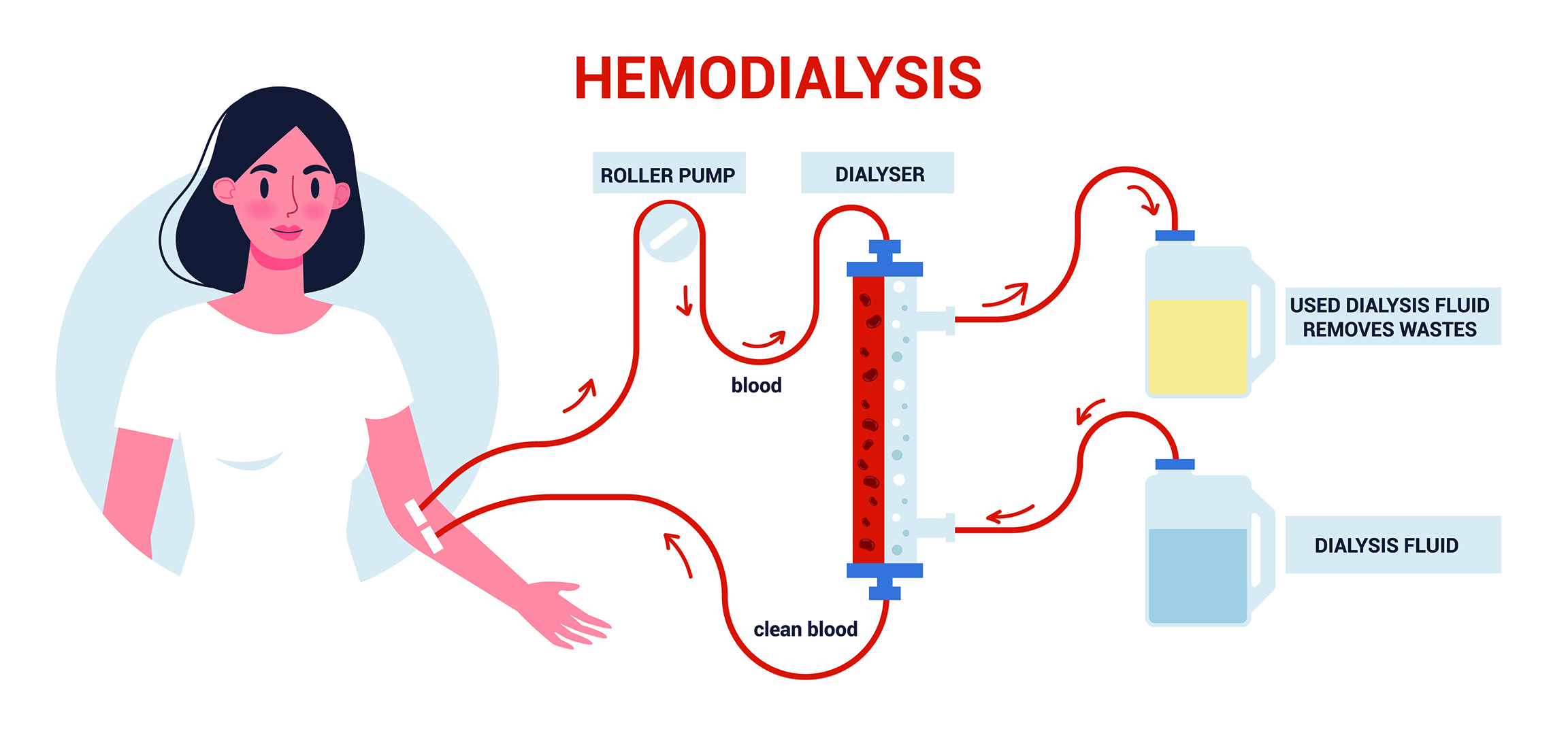 Hemodialysis: Lifesaving Treatment for Kidney Disease - Kalyani Kidney Care Centre